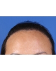 After Hair Transplant &nbsp;Hairline